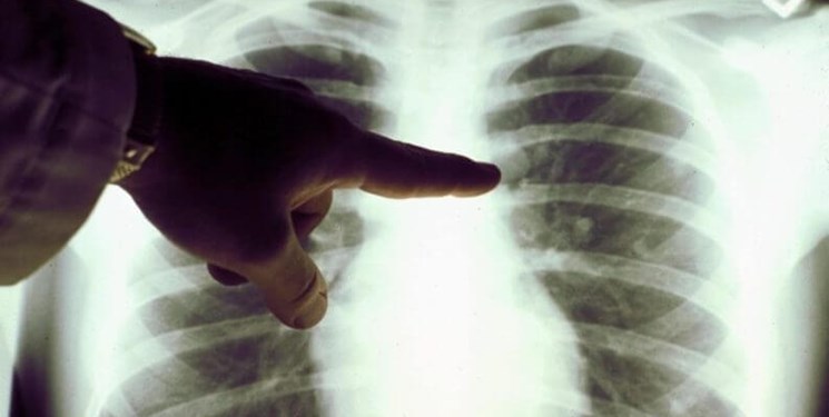 بستری شدن ۱۲۳۱ بیمار کرونایی در مازندران