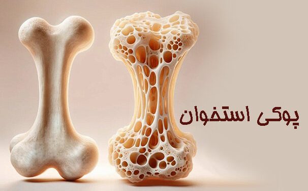 سنجش‌ تراکم استخوان، تشخیص طلایی