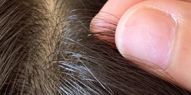 هشدار درباره شیوع شپش سر/ آلودگی به معنای رعایت نکردن بهداشت نیست